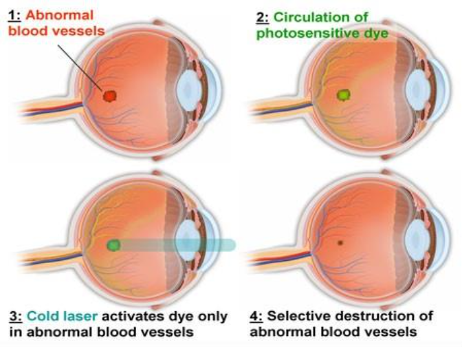 diagrams showing the progression of PDT.docx.png