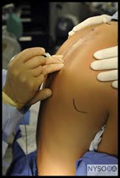Photo of a patients back showing a medical staff member inserting a needle with a thin tube attached, in the middle of the back.